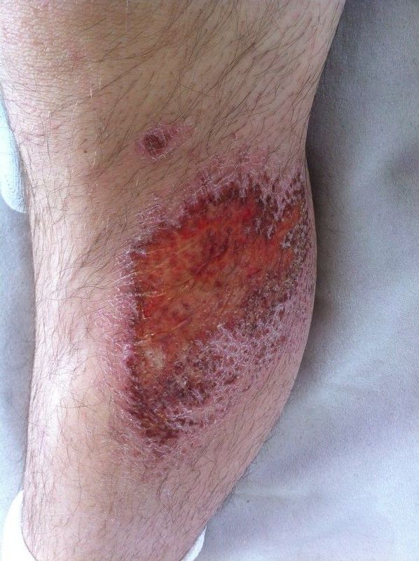 Traitement des écorchures avec DermaSilk