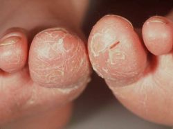 Atopische Zehen
