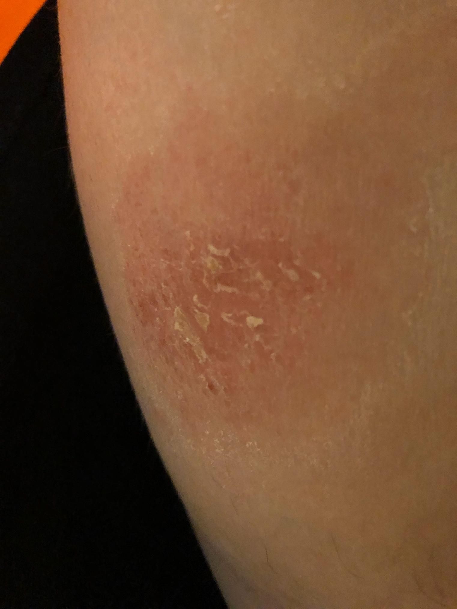 Eczéma aux jambes traitée avec DermaSilk