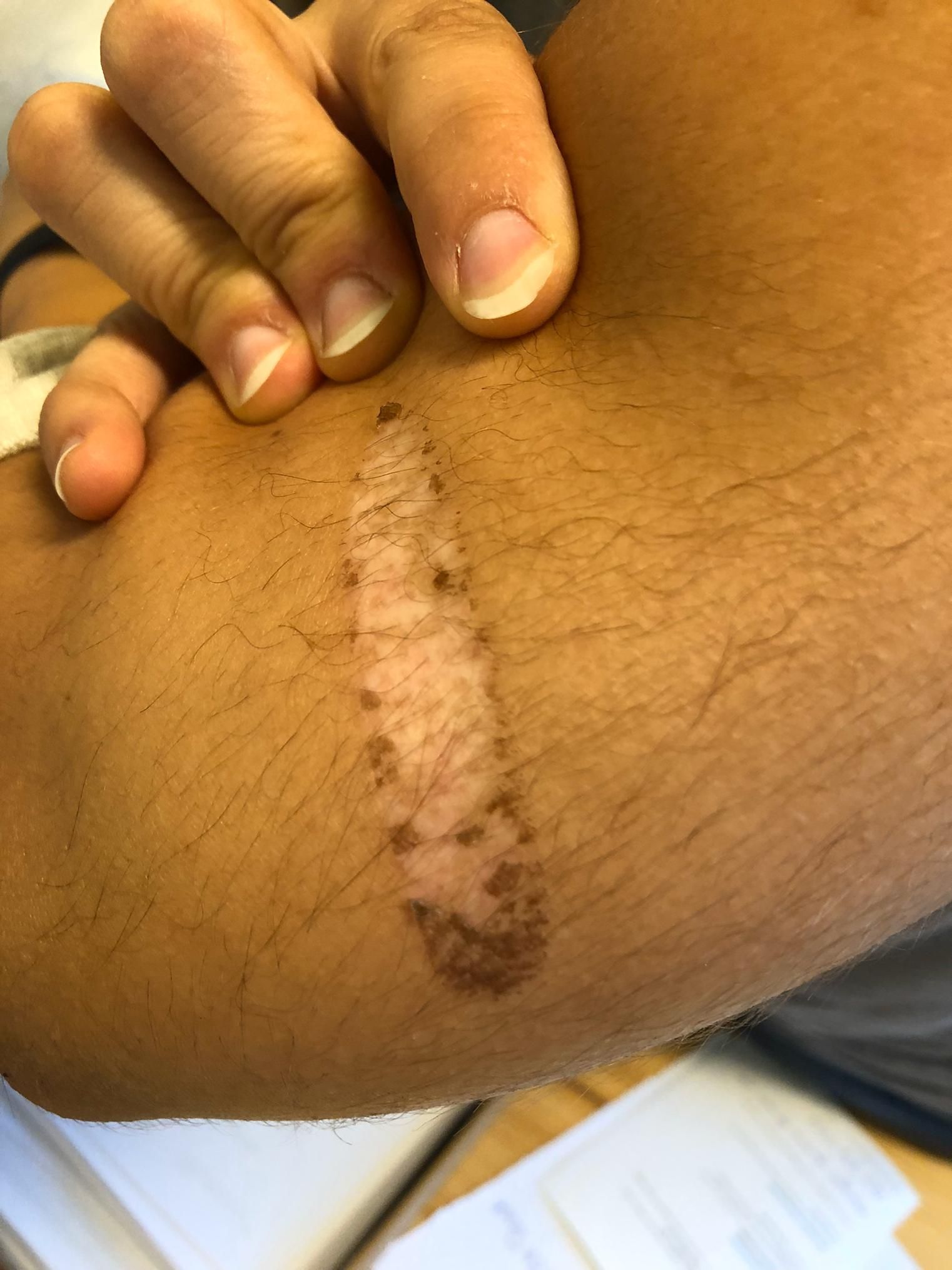 Brûlure traitée avec DermaSilk