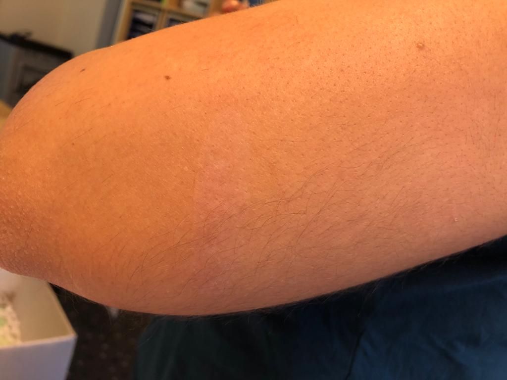 Brûlure traitée avec DermaSilk