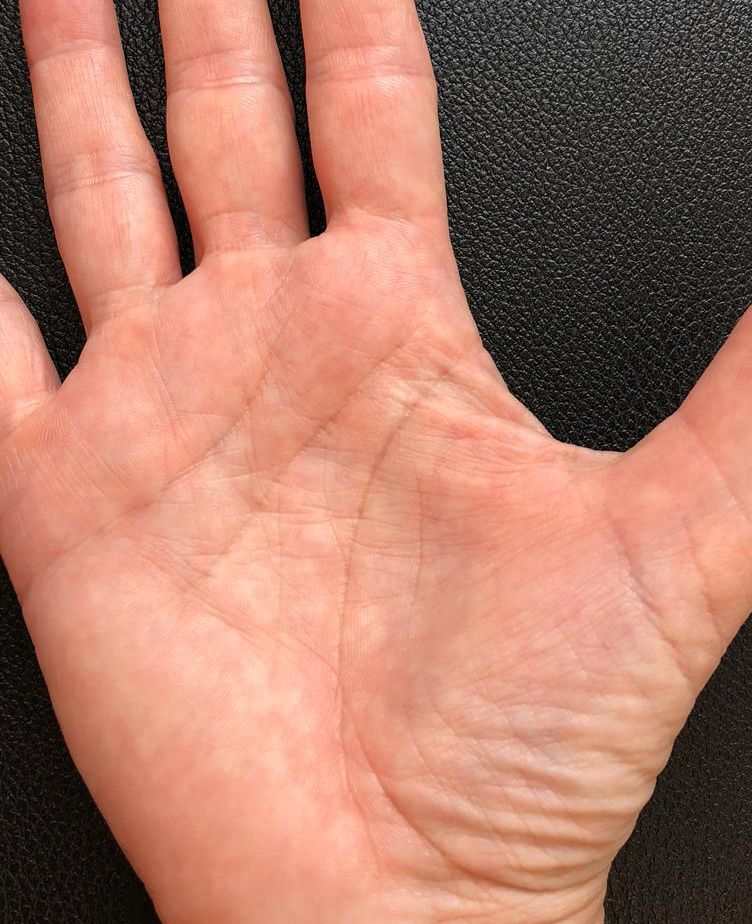 Psoriasis à la main