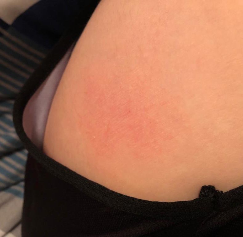 Eczéma aux jambes traitée avec DermaSilk