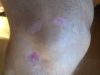 Écorchures sur mon genou