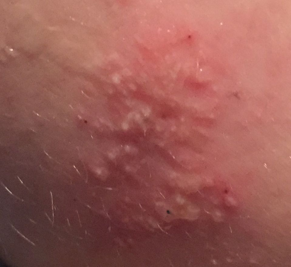 Traiter le lichen de Vidal avec DermaSilk