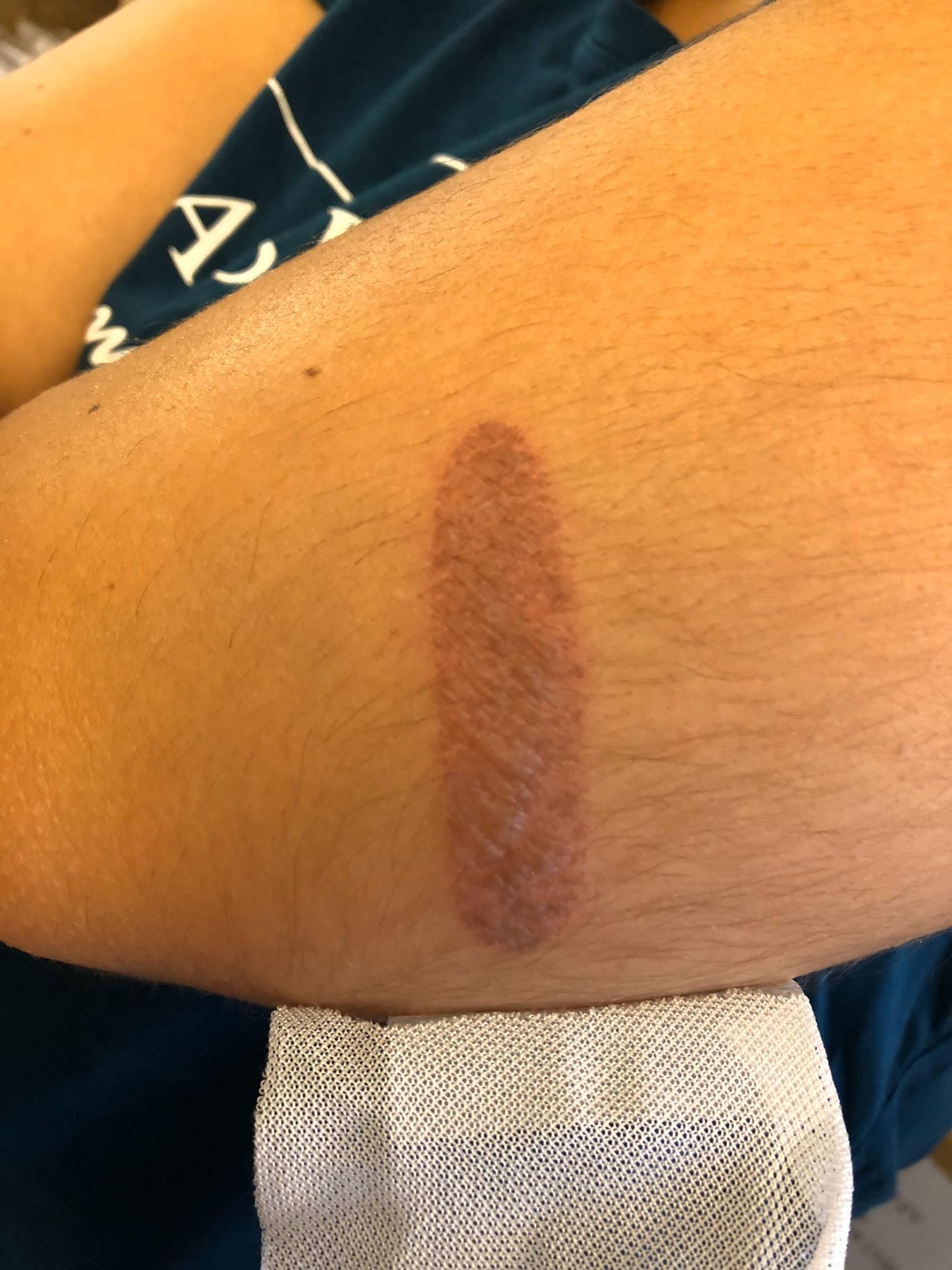 Brûlure traitée avec DermaSilk