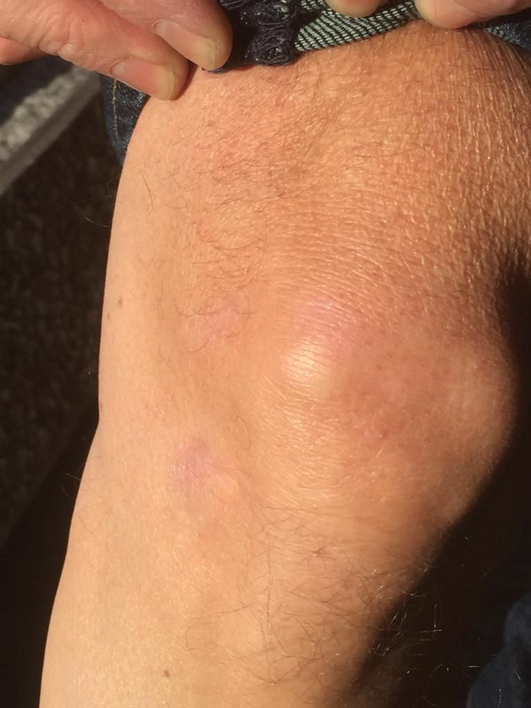 Écorchures sur mon genou