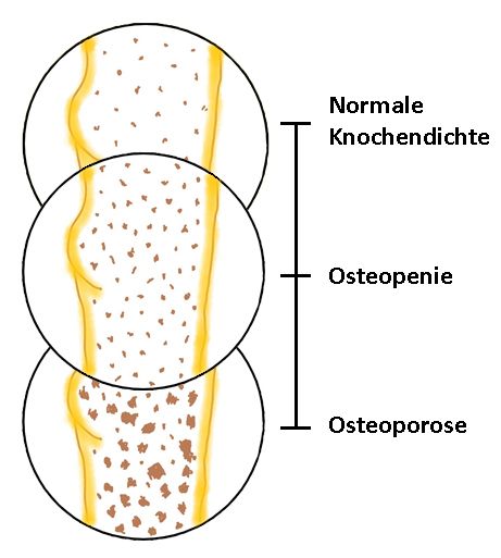 Unterschied zwischen normaler Knochendichte, Osteopenie und Osteoporose