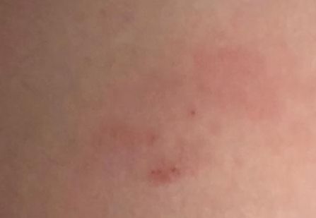 Traiter le lichen de Vidal avec DermaSilk