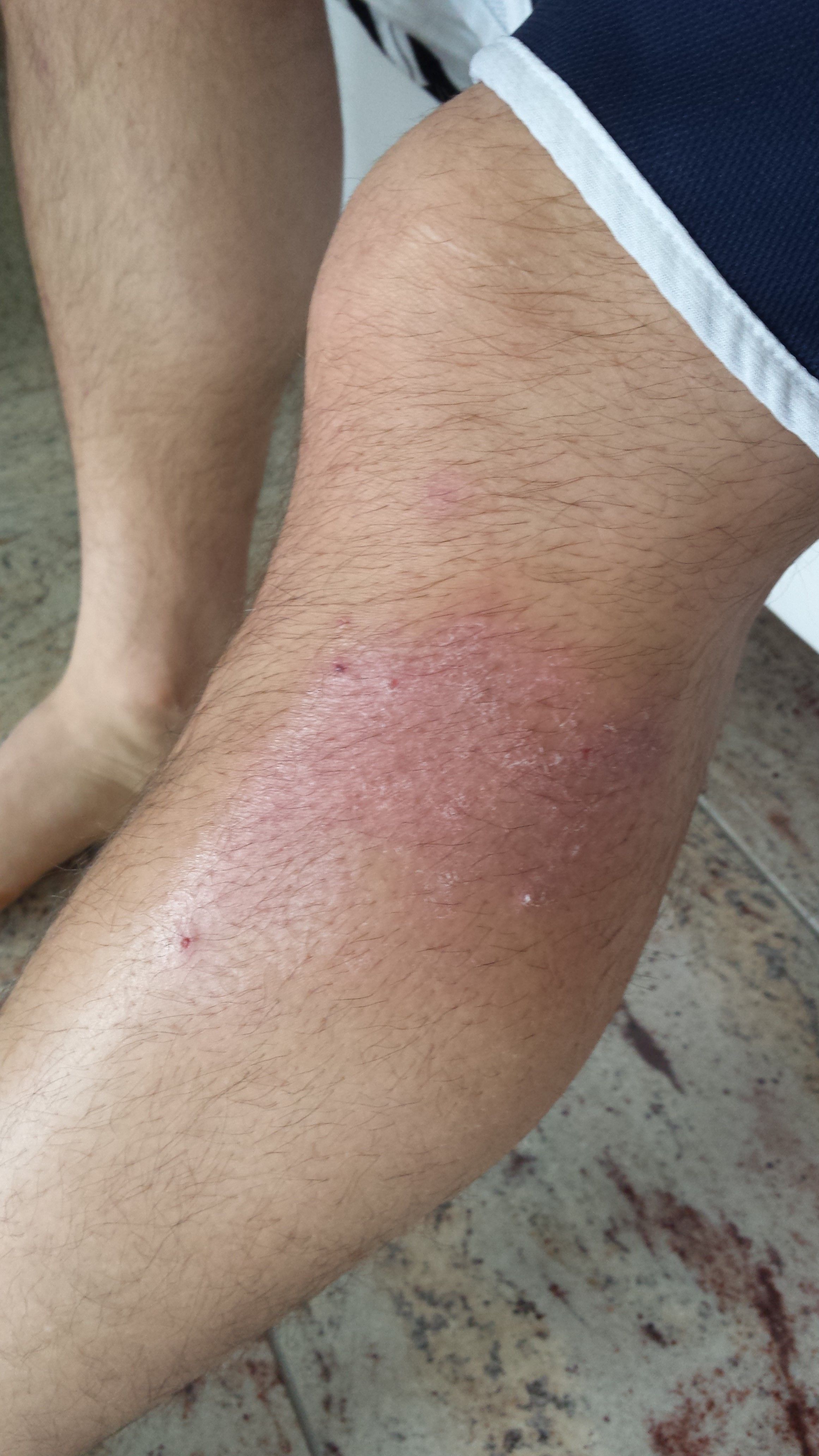 Traitement des écorchures avec DermaSilk