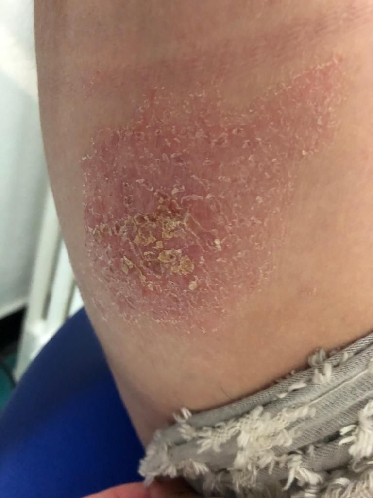 Eczéma aux jambes traitée avec DermaSilk