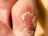 Psoriasis au pied