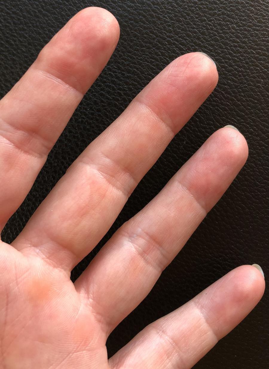 Cicatrice après une opération du doigt, traitée avec DermaSilk