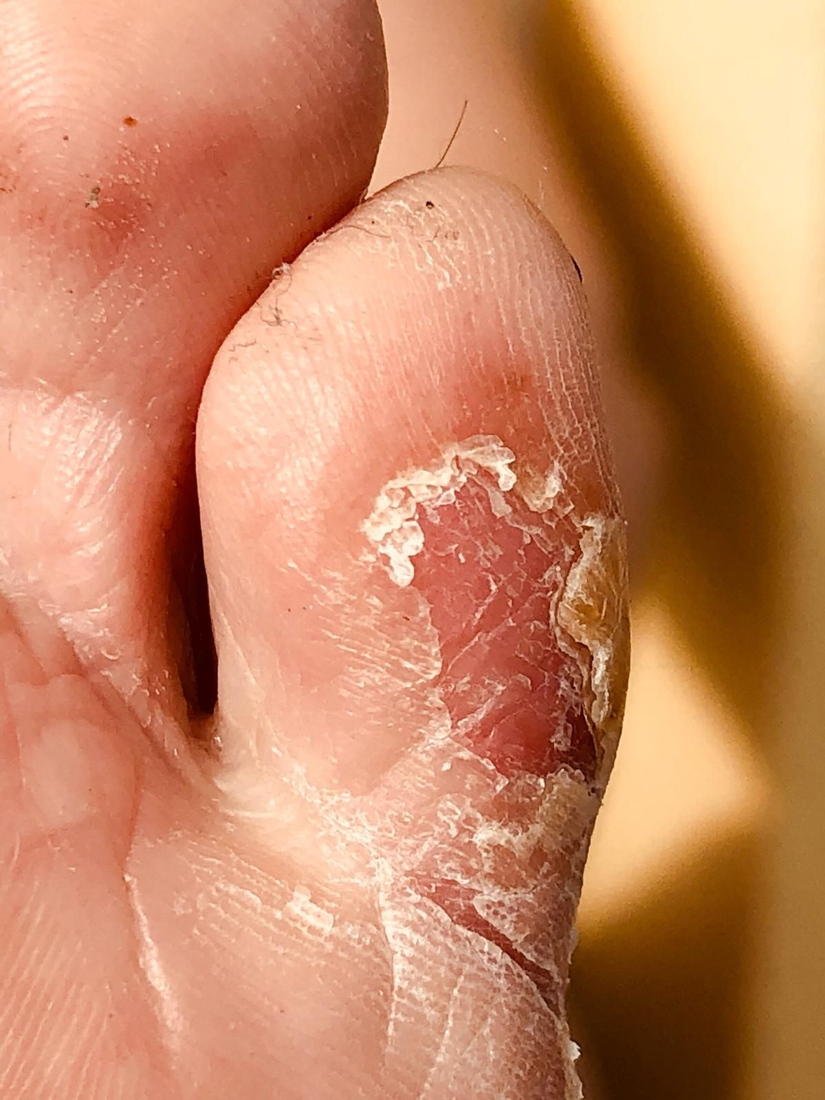Psoriasis au pied