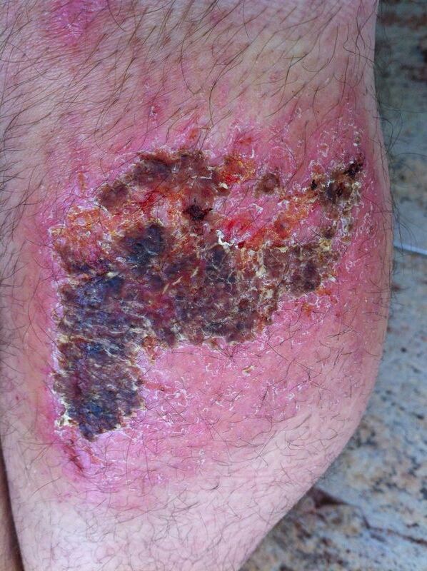 Traitement des écorchures avec DermaSilk