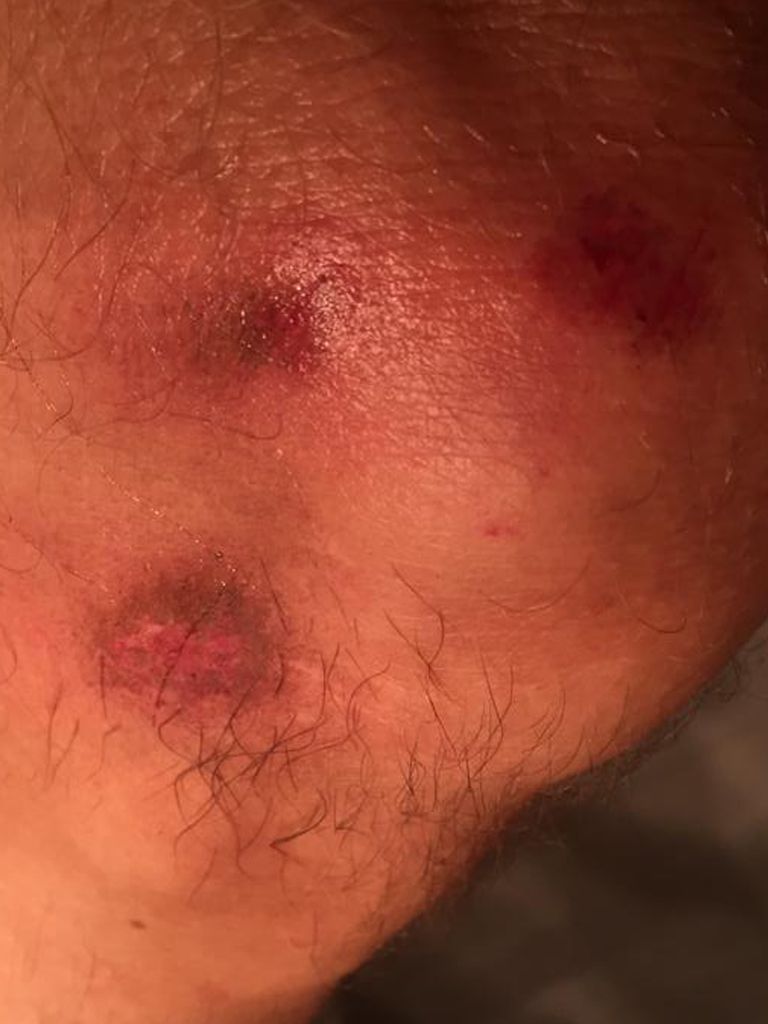 Écorchures sur mon genou