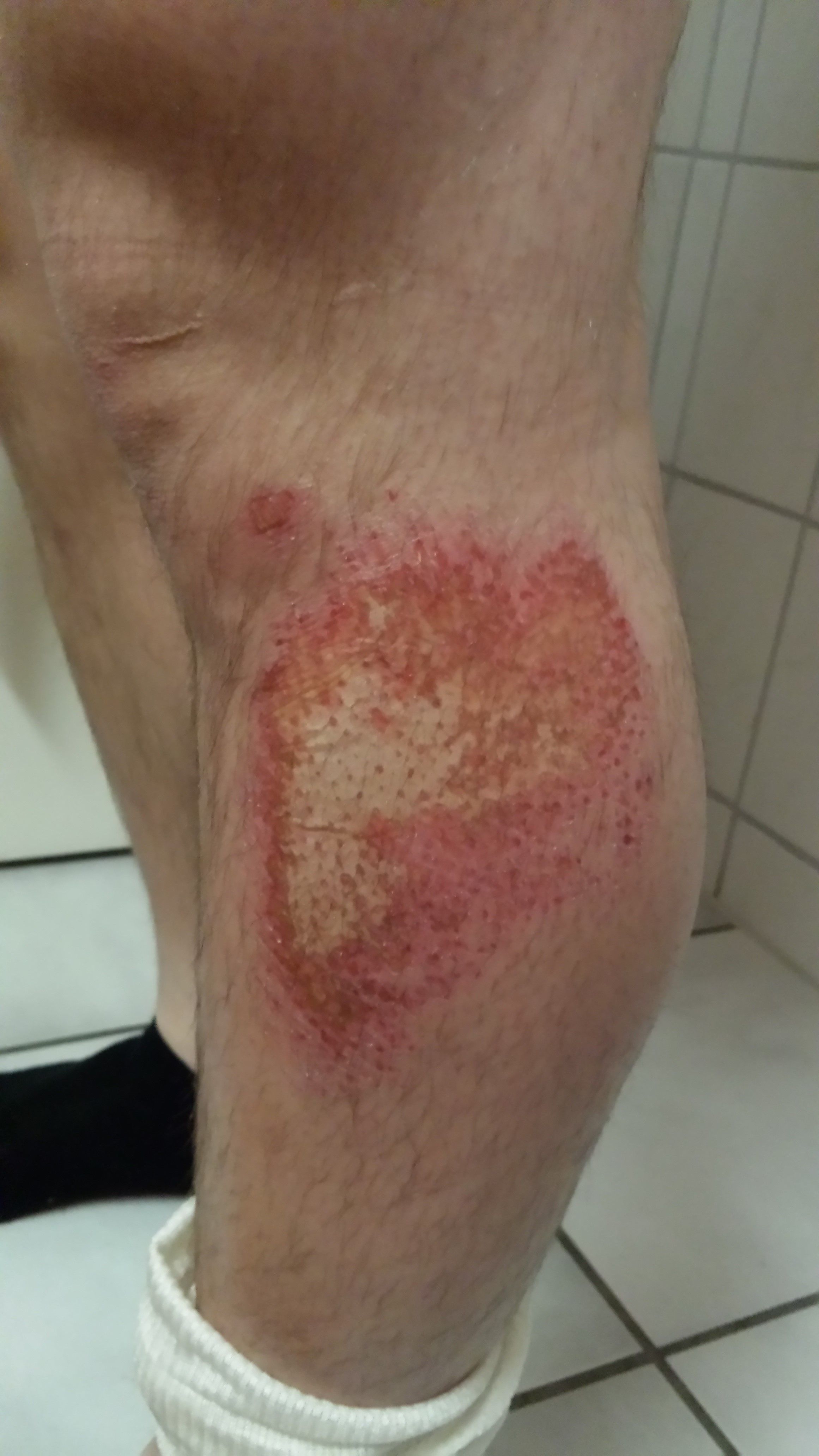 Traitement des écorchures avec DermaSilk