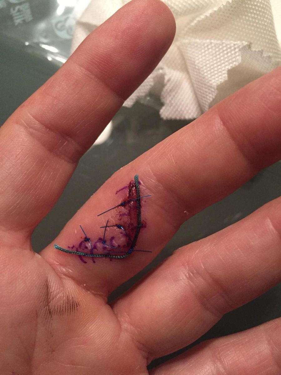 Cicatrice après une opération du doigt, traitée avec DermaSilk